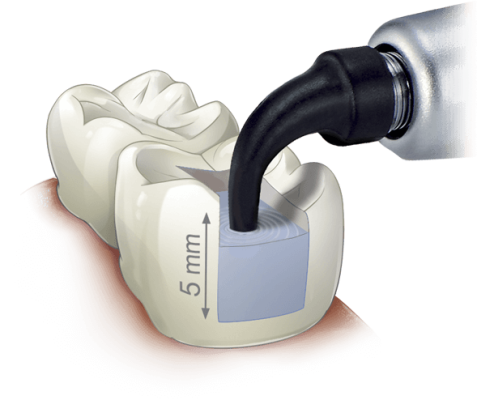 SonicFill™ 2 Single-Fill™ Bulk Fill Dental Composite System | Kerr Dental