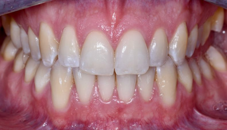 Restorative treatment of a persistent, unilateral open bite with direct composite table tops