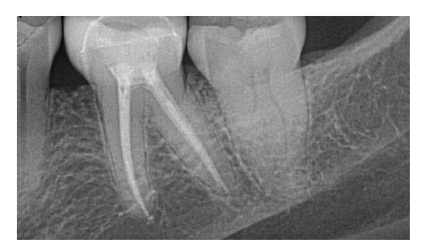 Miller Traverse™ & elements™ IC Endodontic Treatment Case Study - Dr. Matthew Miller