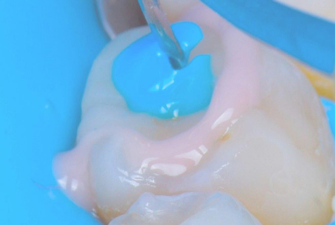 Smart cements for indirect bonded ceramic restorations 