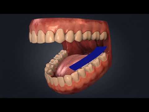 Watch Kerr's ZIR-CUT™ Diamonds Remove a Zirconia Crown