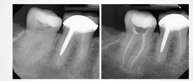 NiTi Rotary Shaping File before and after NiTi Rotary Shaping File before and after