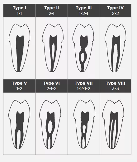 Vertucci’s Canal Classification Vertucci’s Canal Classification