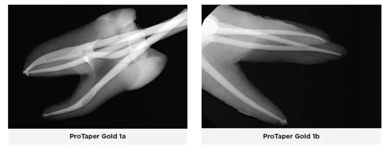 the ProTaper Next files use M-wire technology which improves resistance to cyclic fatigue, decreases the risk for file separation, and increases the ProTaper Next files use M-wire technology which improves resistance to cyclic fatigue, decreases the risk for file separation, and increases