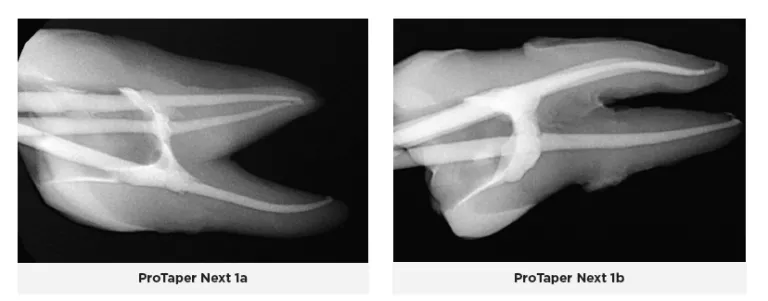 The files have non-end cutting tips, convex, triangular cross-sections with a changing helical angle and pitch over their cutting blades, and rotate on their center of mass(14). The Gold-wire technology in the ProTaper Gold files is a post-machining heat treatment process that allows for increased flexibility and strength and makes them more resistant to fracture when compared to ProTaper Universa The files have non-end cutting tips, convex, triangular cross-sections with a changing helical angle and pitch over their cutting blades, and rotate on their center of mass(14). The Gold-wire technology in the ProTaper Gold files is a post-machining heat treatment process that allows for increased flexibility and strength and makes them more resistant to fracture when compared to ProTaper Universa
