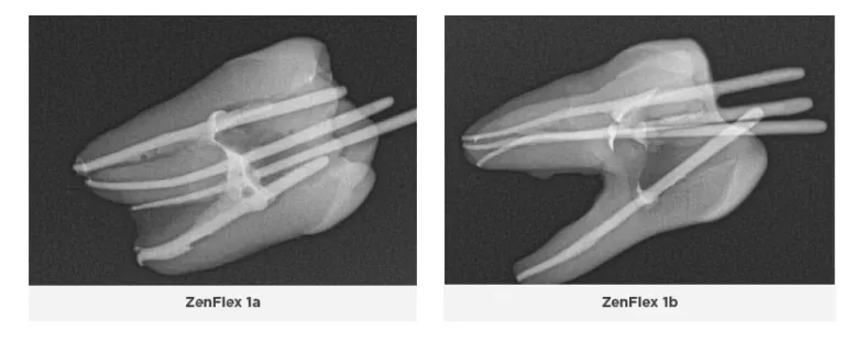 Moreover, the time to treat each tooth was 30-50% faster than the ProTaper Gold and Next and file systems because the ZenFlex files cut more efficiently. Noticeably less binding and rotational force was applied to the tooth when using the ZenFlex files. Moreover, the time to treat each tooth was 30-50% faster than the ProTaper Gold and Next and file systems because the ZenFlex files cut more efficiently. Noticeably less binding and rotational force was applied to the tooth when using the ZenFlex files.